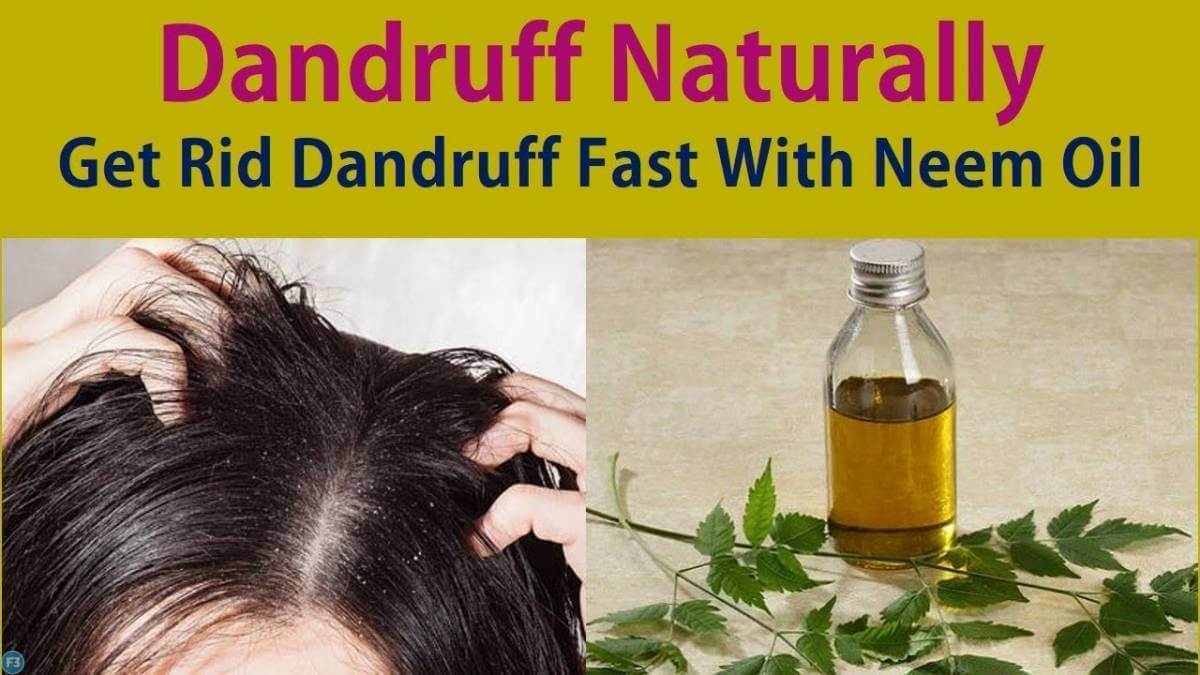Neem oil for dandruff